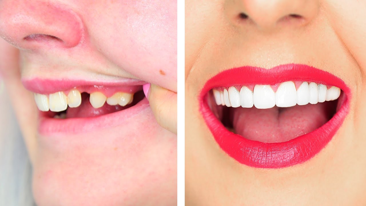 i-got-new-teeth-veneers-cost-my-experience-by-tashaleelyn