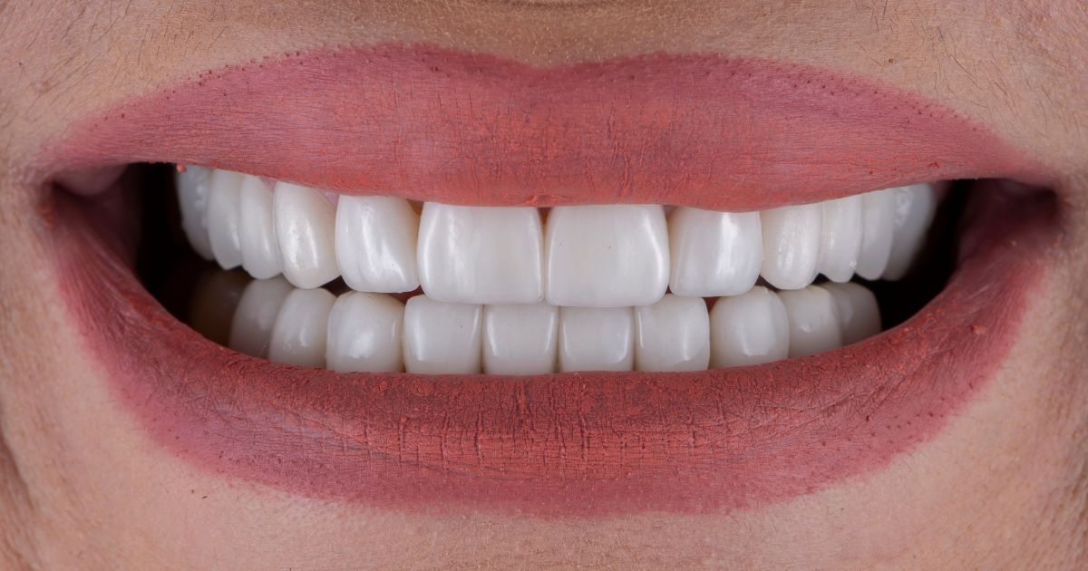 Addressing The Gap Issue_ Can Veneers Effectively Close Gaps Between Teeth