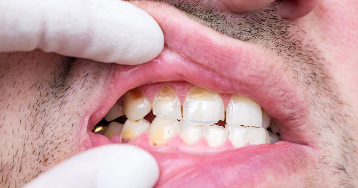 Signs That Your Veneers May Need Replacement